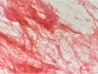 BỆNH LẬU – DẤU HIỆU VÀ CÁCH NHẬN BIẾT